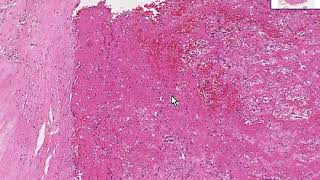 Artery Thrombus, Atheroscl Plaque