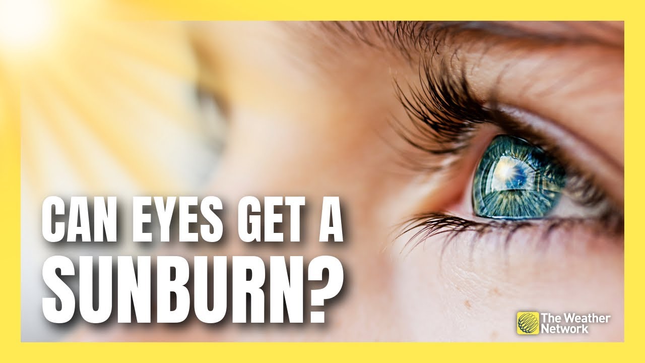 Can You Really Get A Sunburn On Your Eyes Youtube 