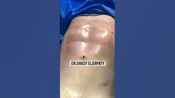 نتيجة شفط دهون البطن ونحت الجسم في Change Me Clinic شفط الدهون 