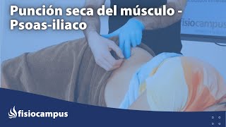 PUNCIÓN SECA   Aplicación práctica de PS en el músculo Psoas iliaco