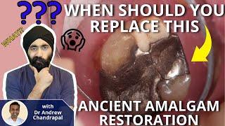 When Should I Replace This Ancient Amalgam Restoration  PDP083