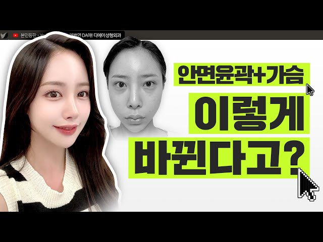 요청 많았던 윤곽, 가슴 5개월 변화ㅣ 윤곽, 가슴, 눈, 코 수술 브이로그