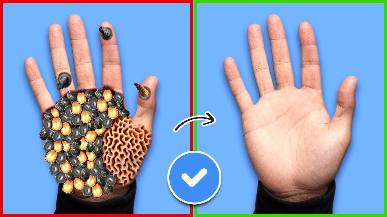 asmr-remove-ticks-maggots-from-hand-severely-injured-treatment
