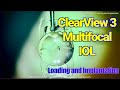 Clearview 3 multifocal lens  loading and insertion shannon wong md