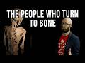 The Who Slowly Turn to Bone While Alive