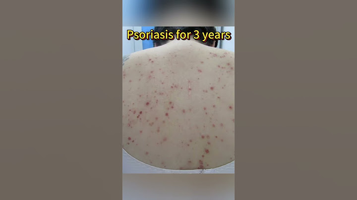 Psoriasis for 3 years.Countless times I want to give up #psoriasis