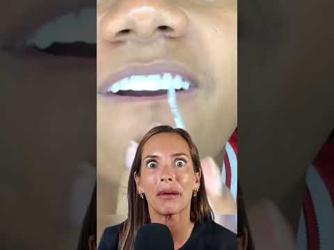 Video: Cómo quitar el adhesivo dental de las encías: 10 pasos