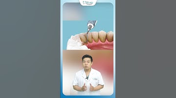 Điều Gì Sẽ Xảy Ra Khi Đi Lấy Cao Răng Tại Phòng Khám | Nha Khoa Minh Châu