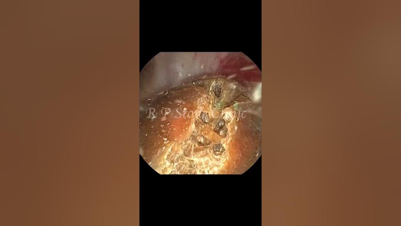 Approx 1 4 cm kidney stone removed with rirs technology youtube