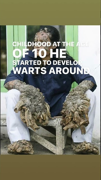 Indonesian Carpenter Dede Koswara “Tree man” #dedekoswara #treeman #shorts  #short  #shortvideo