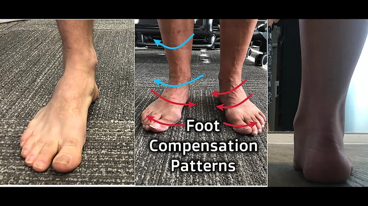 Foot Compensation Patterns