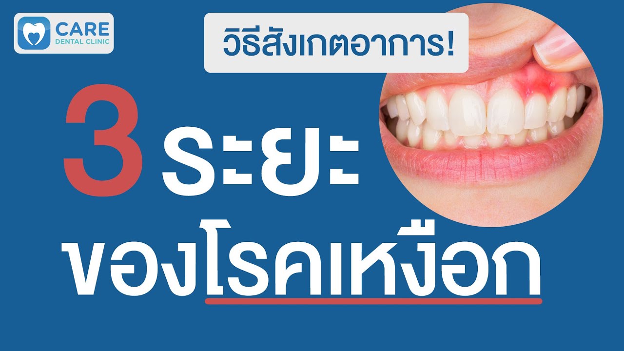 ก้อน เนื้อที่ เหงือก  New  3 ระยะของโรคเหงือก | Care dental clinic