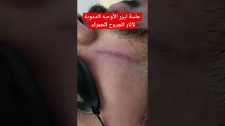 جلسة ليزر الأوعيه الدمويه لعلاج آثار الجروح الحمراء.Vascular laser for erythematous scar.