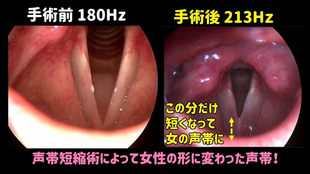 声を高くする手術3年後 女性の声帯のまま 声帯と声の比較 インタビュー Youtube