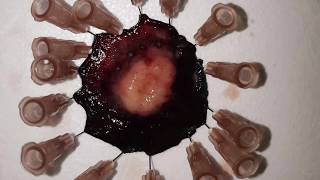 ESD of a Type 3 Gastric NET