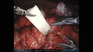 V258 LAPAROSCOPIC ROBOTIC-ASSISTED CONVERSION FROM DUODENAL SWITCH TO GASTROJEJUNOSTOMY FOR SEVE...