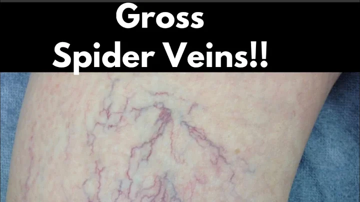 Spider Veins Are Gross but Also a Danger Sign of Poor Cardiovascular Health! What to Do to Reverse!