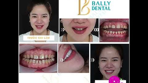 Bọc Răng Sứ Khắc Phục Răng Thưa Và Răng Nhiễm Tetracyclin Triệt Để