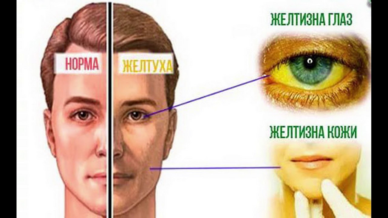 Почему желтеет мужчина. Желтухи цвет кожных покровов. Желтоватый оттенок кожи и глаз. Желтушность при гепатите.