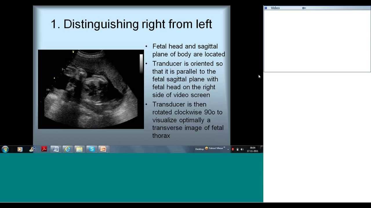 Download Fetal Echocardiography Basic Views by Dr Sejal Shah