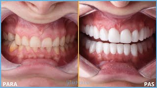 Transformimi I Buzëqeshjes Me Kllëfë Zirkoni Imperial Dental Center