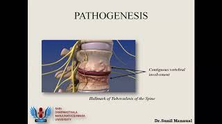 Tuberculosis of the Spine