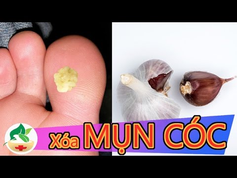 Mẹo chữa Mụn cóc bằng Tỏi