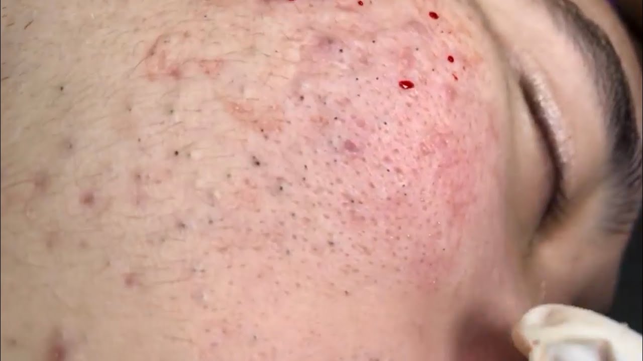 🔥 Pimple Popping 2020 Video| Blackheads full face| Blackheads removal