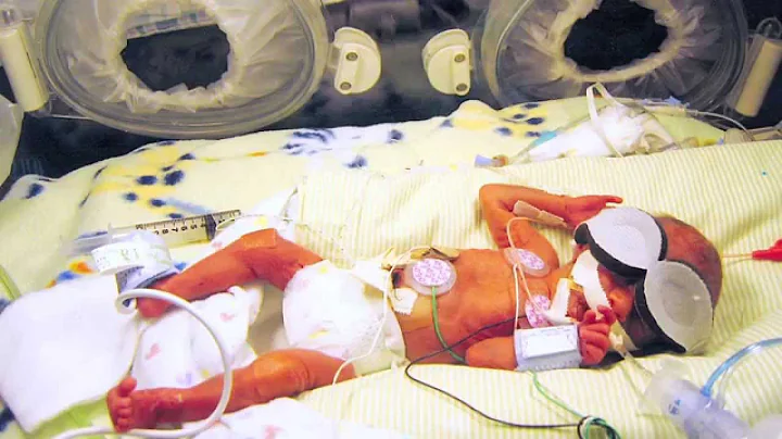 Can a baby of 25 weeks survive? (2023)