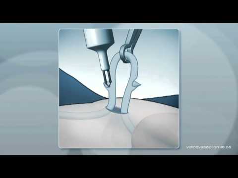 Video: Vasektomija Bez Skalpeļa: Procedūra, Ieguvumi, Riski Un Atveseļošanās