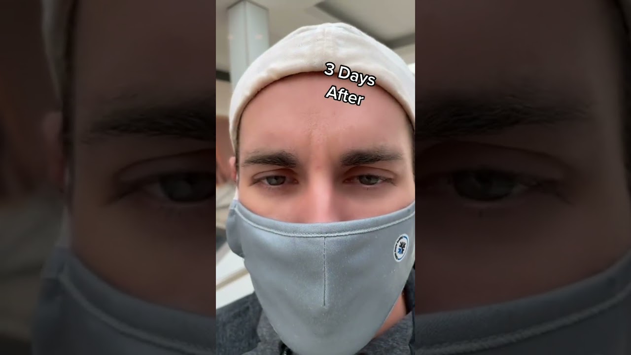 How long does it take to go from NoTox to Botox? 