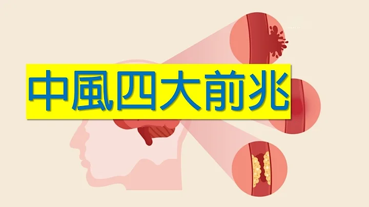 如何預防中風_不可不知的四個中風徵兆_高血壓中風的頭號大敵 - 天天要聞
