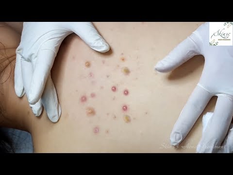 Back Acne Treatment - Looks like nothing but having much Part 