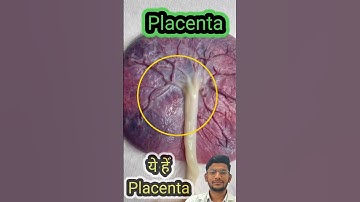 Placenta / Umbilical Cord 😱....            #Placenta #pregnancy #umbilical #labour #baby #doctor