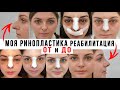 МОЯ РИНОПЛАСТИКА | Дневник реабилитации | Все ощущения