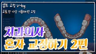 [V-log] 치과의사 혼자 셀프 교정하기 - 교정시뮬레이션(2탄) #교정 과정 보여드립니다!