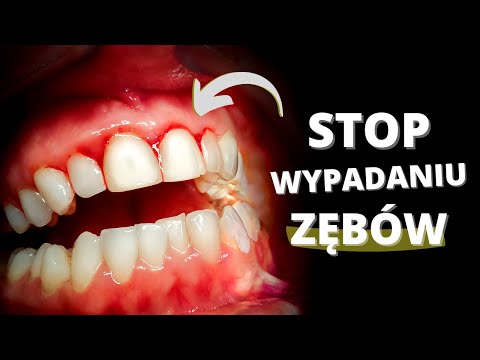 Wideo: 4 sposoby na pozbycie się połkniętych zębów