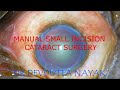 Manual small incision cataract surgery