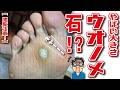 【閲覧注意】足の裏に大きな石ころ！皮膚科に見放された女性のフットケア