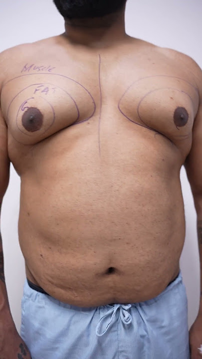 Gynecomastia Surgery #shortvideo #dezireclinicindia