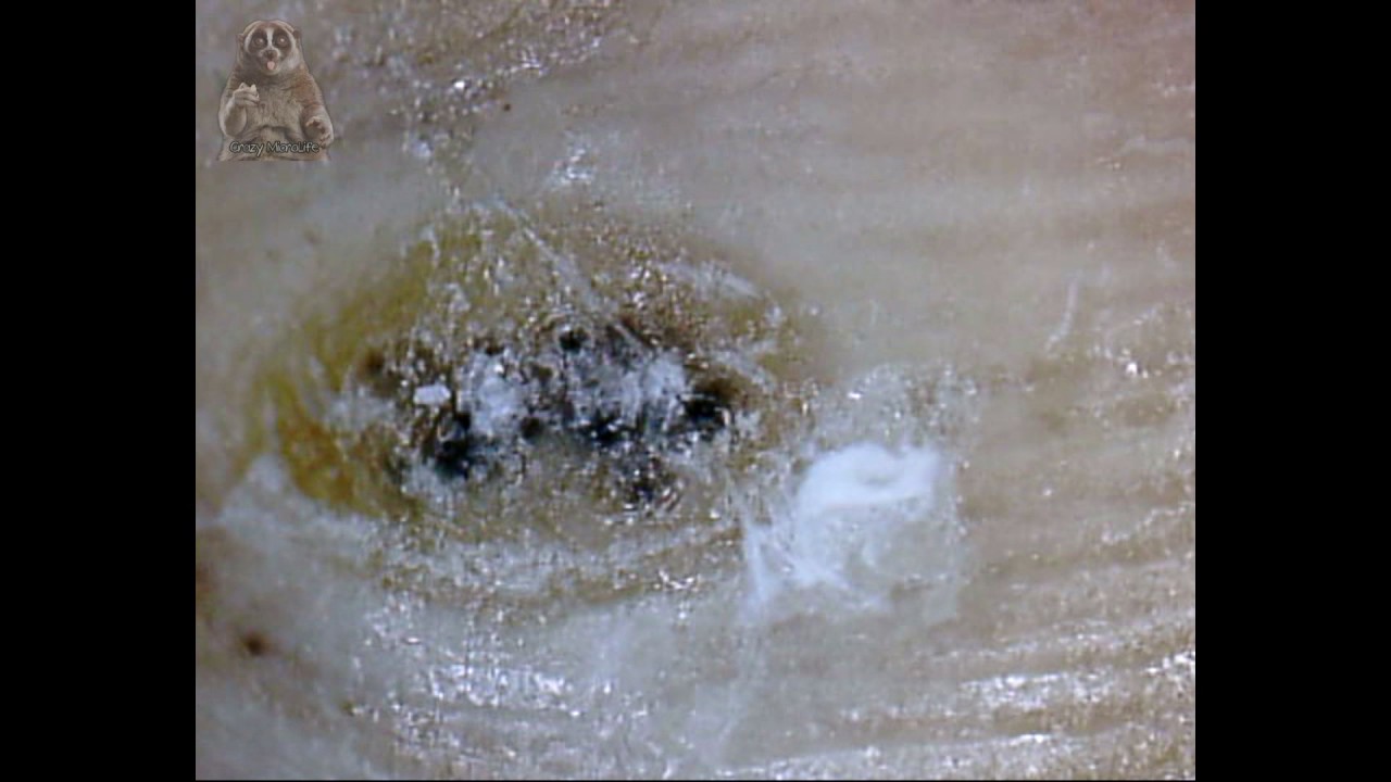 Foot Wart Under Microscope YouTube