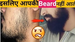 इस लिए आपकी Beard Grow नहीं होती |Hindi|How to get rid of patchy beard