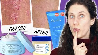 The 3 Best Eczema Products You Can Get Without A Prescription