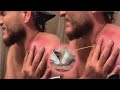 Popping huge blackheads and pimple popping  best pimple poppings 06