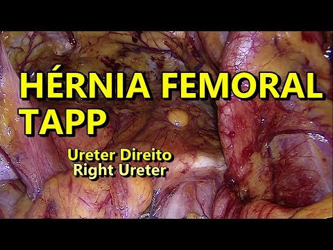 Bilateral Femoral Hernia for Video - No Stapler - FullHD 60fps + Two GoPro