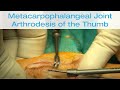 Metacarpophalangeal Joint Arthrodesis of the Thumb