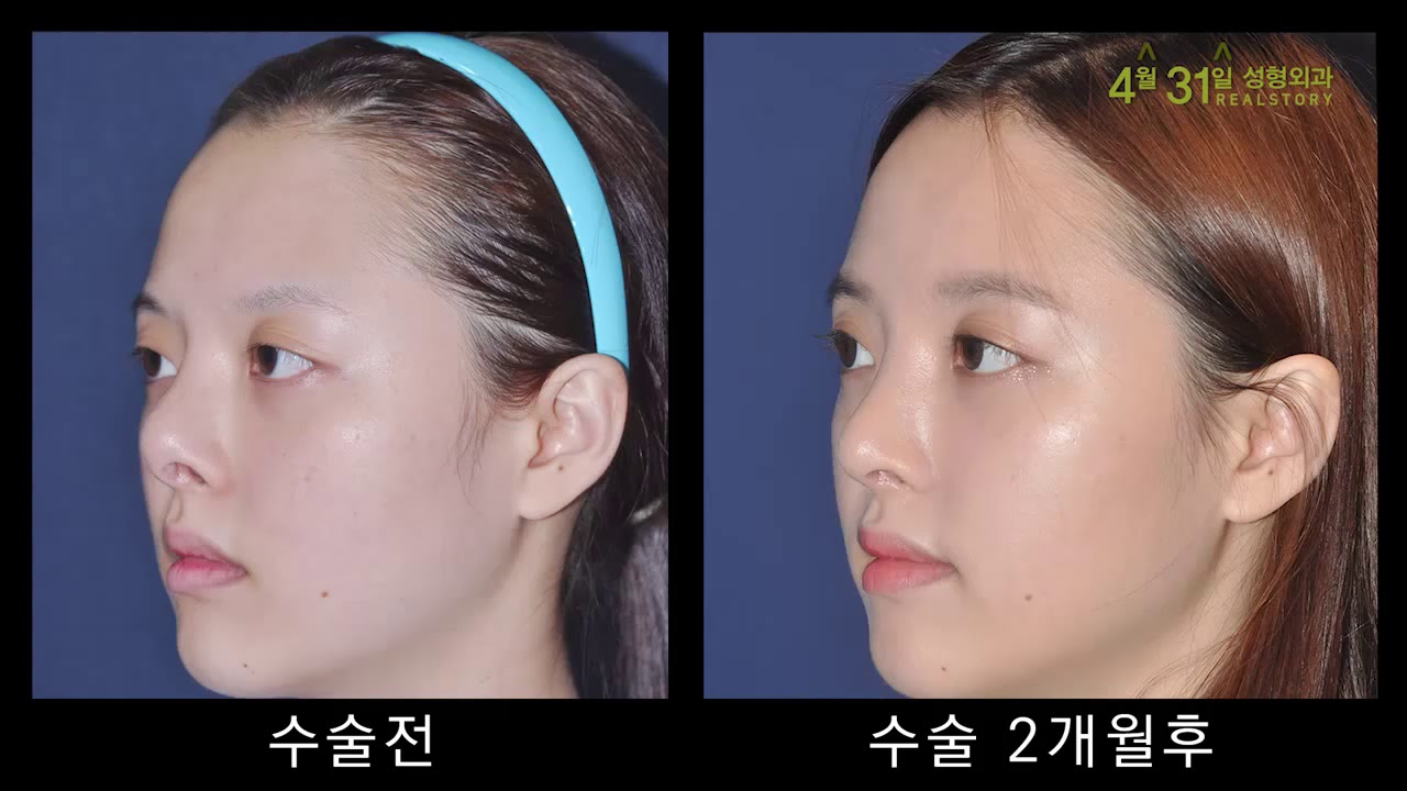 [뷰티/성형] 부모님상/하안검+눈썹하거상 상담후기(병원비교-4월31일, 시작, 김현진)