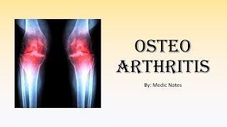 [Ortho] Osteoarthritis - risk factors, causes, signs & symptoms, xray findings, treatment