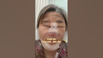 Short video|Diện mạo thay đổi bất ngờ sau khi thực hiện combo nâng mũi - độn cằm