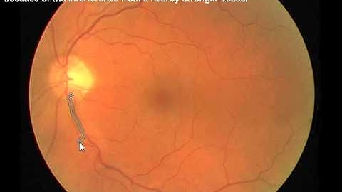 Interactive retinal vessel extraction from low quality fundus images